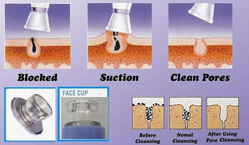 may hút mụn , trị mụn , cách trị mụn tại nhà , chăm sóc da dầu , chăm sóc da nhờn